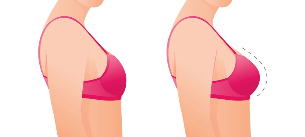 Comparison of Breast Expansion Methods